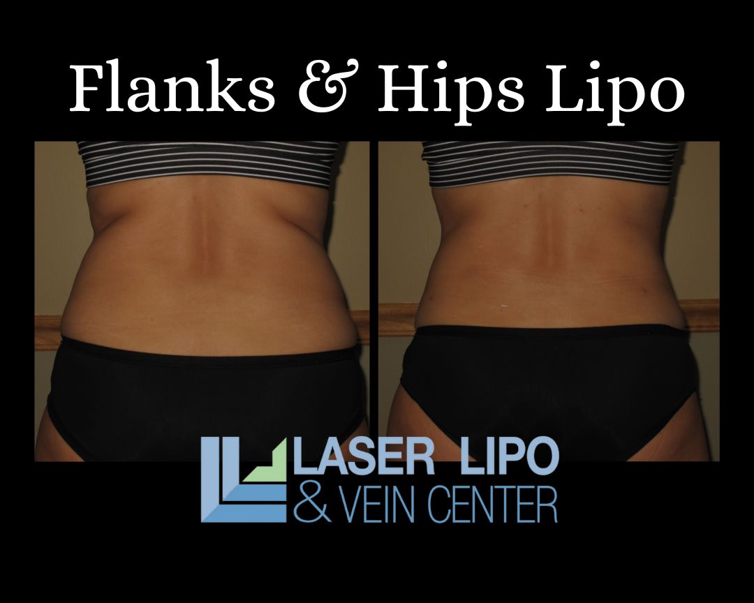 Achieve a Snatched Waist with Lipo 360 in St Louis MO | Laser Lipo 