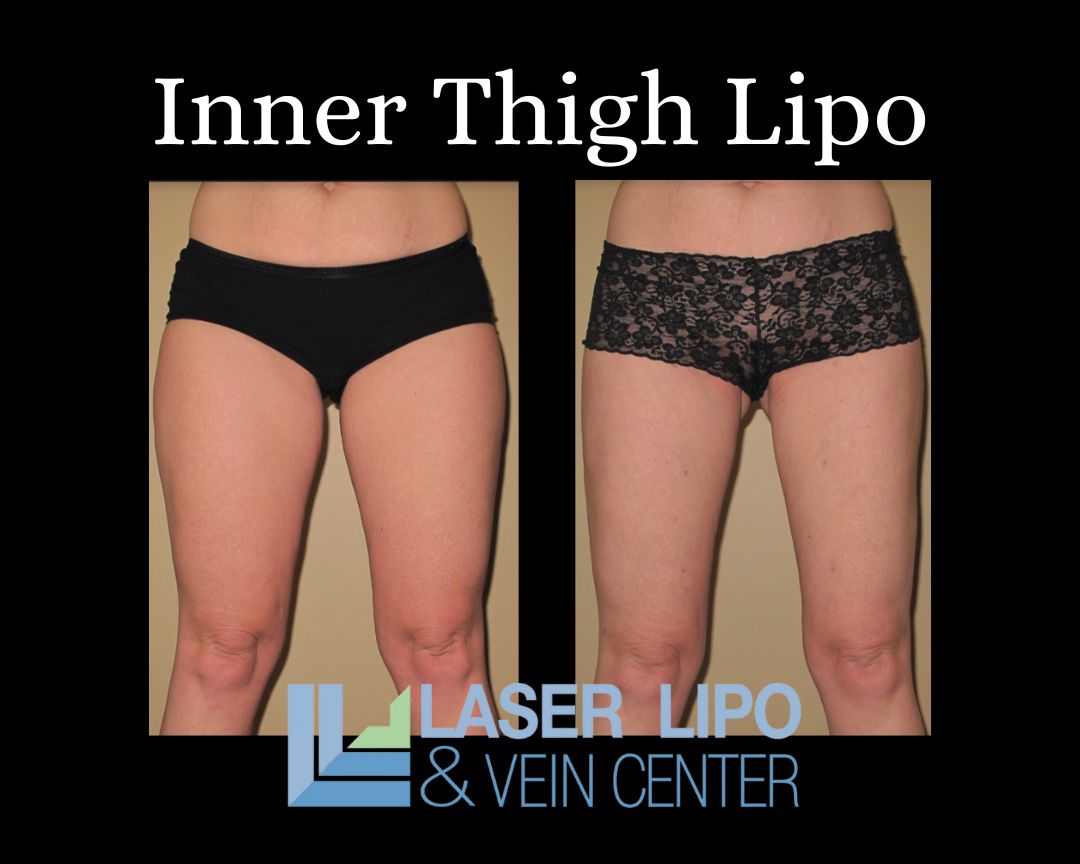 St Louis Inner Thigh Liposuction Laser Lipo and Vein Center