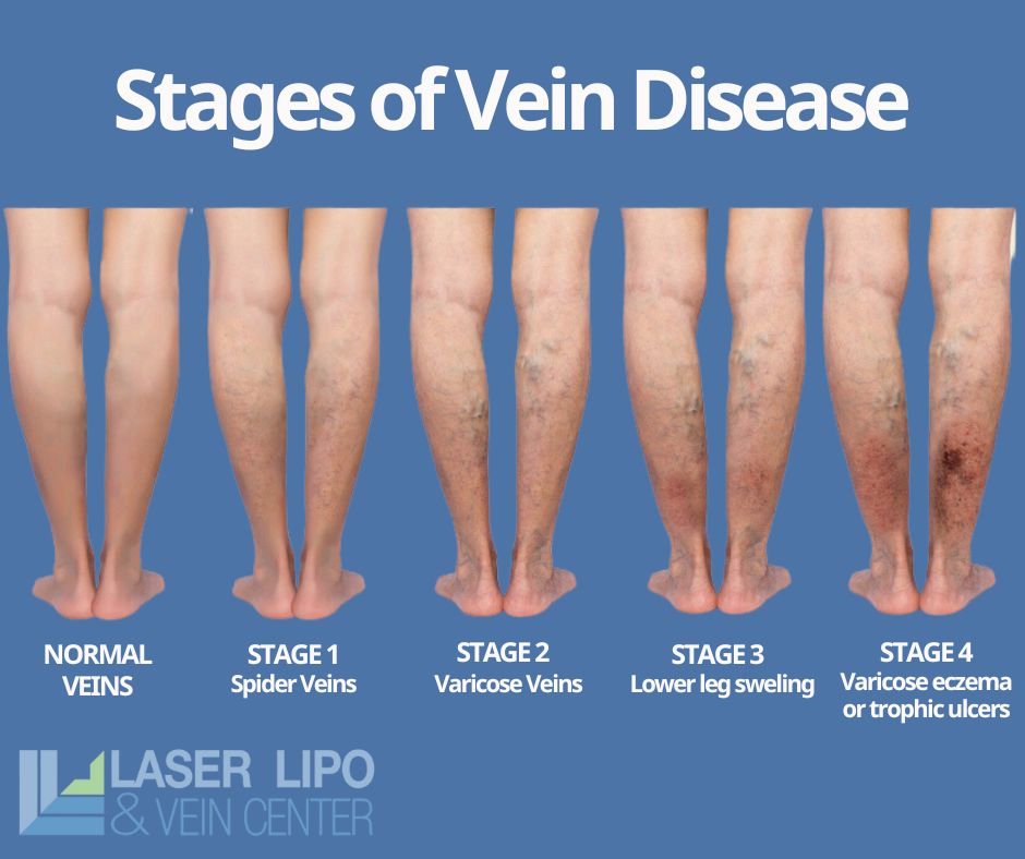 Understanding the Importance of Vein Health Laser Lipo and Veins