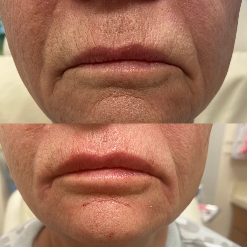 https://www.laserlipoandveins.com/wp-content/uploads/2023/08/St-Louis-lip-filler-fine-lines-treatment.png