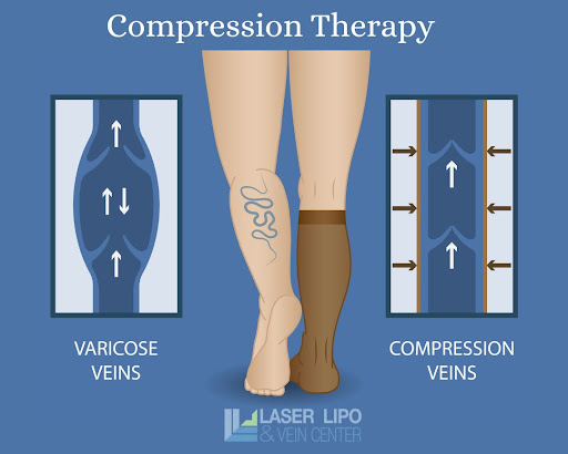 Lymphedema Stocking - Compression Garments