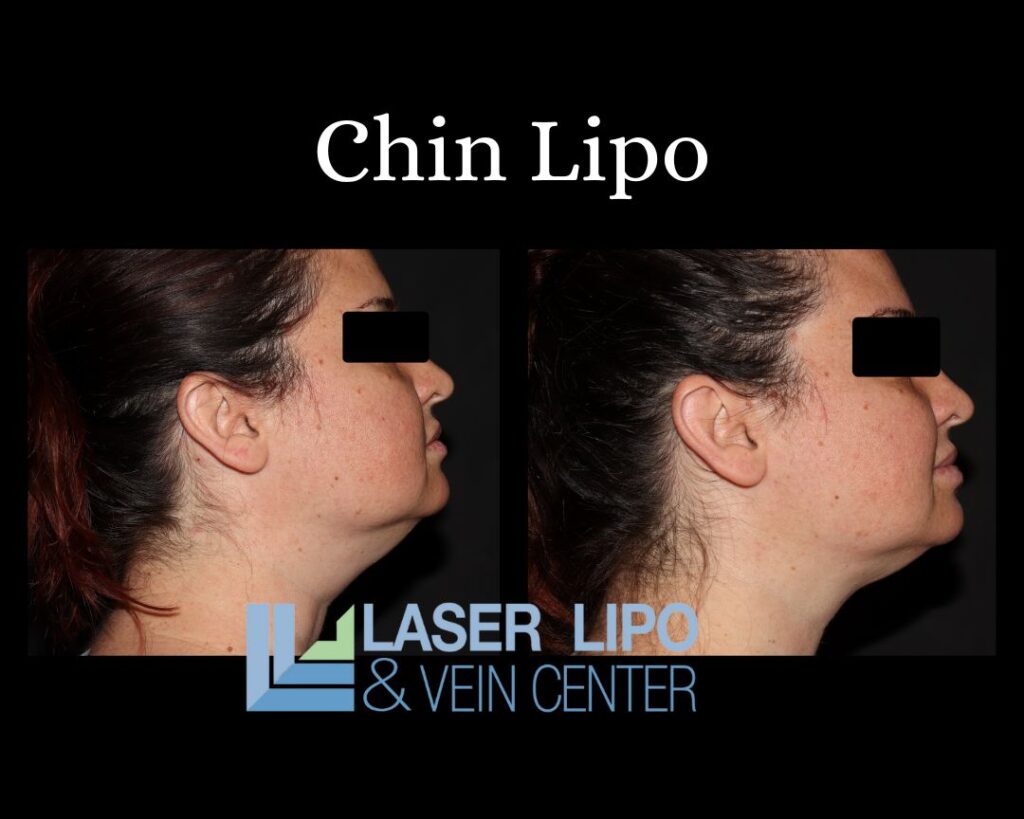 Chin Lipo and Non Surgical Neck Lift Laser Lipo and Veins